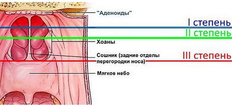 Аденоиды