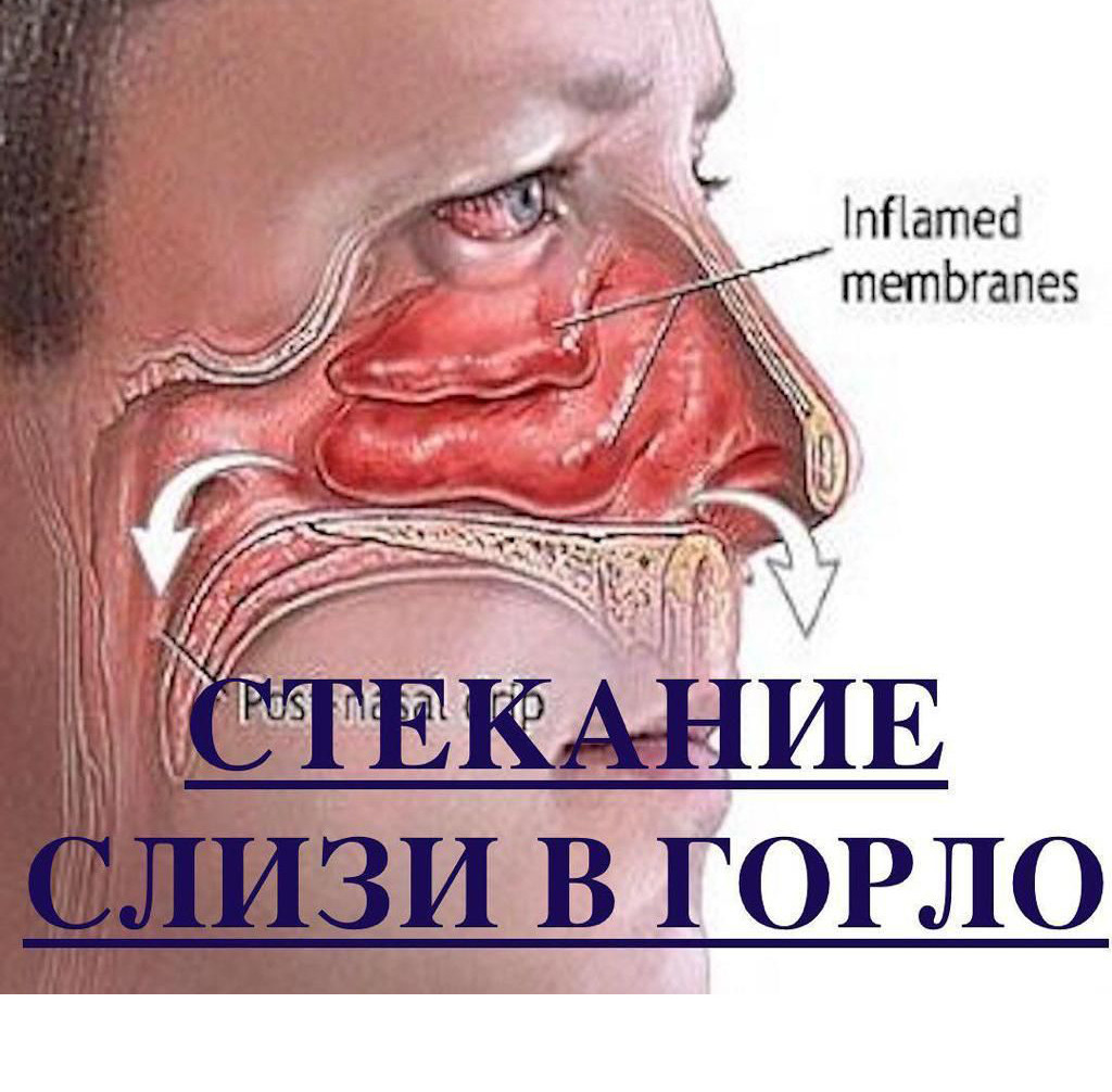 Синдром постназального затекания